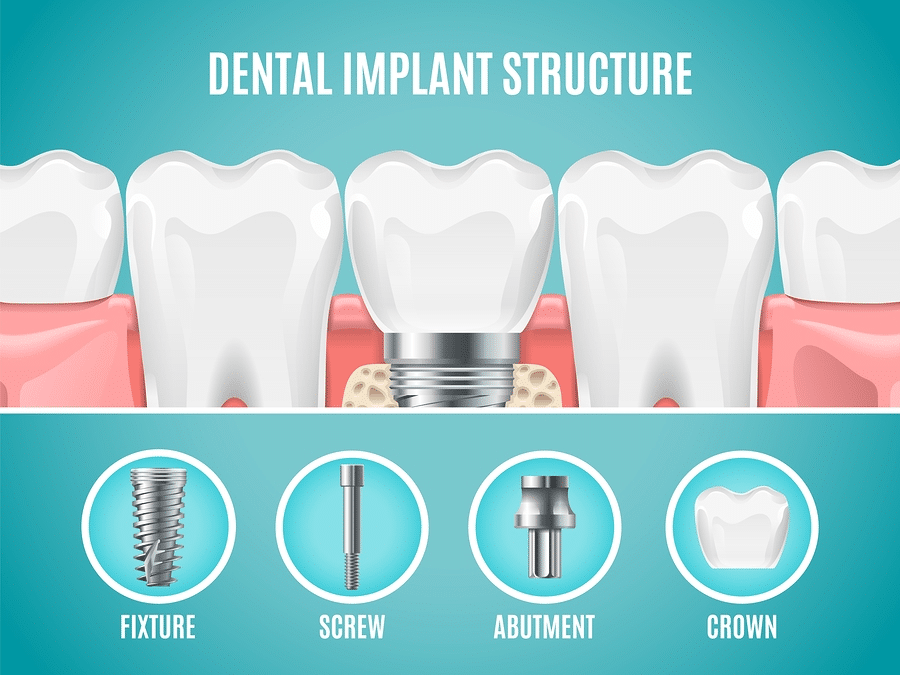 Dental Implants 2